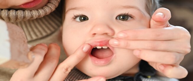 علاج تورم الشفاه